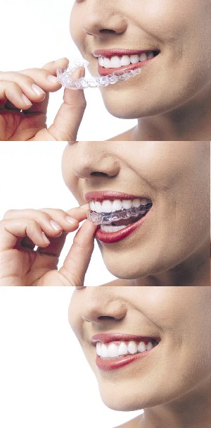 invisalign 1